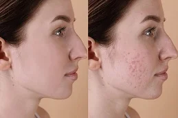 Acne Treatment in Dubai