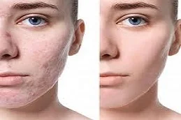 Acne Treatment