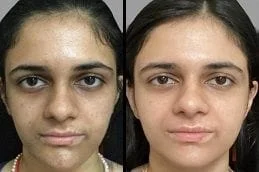 Before-After-Cold-Peel-in-Dubai