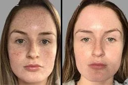 Before-After-Cold-Peel