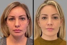 Before After Dermal Fillers in Dubai