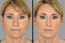 Before After Dermal Fillers