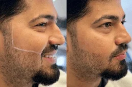 Before-and-After-Laser-Hair-Removal