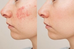 Best Acne Treatment Dubai