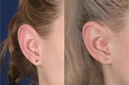 Best Earlobe Reduction befor after
