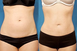 Best liposuction Dubai