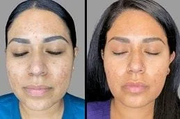 Cold-Peel-Before-After