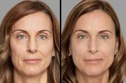 Dermal Fillers Before After