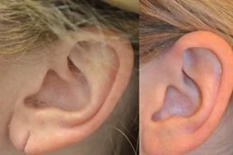Earlobe Reduction before and after