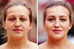 Glutathione-Injections-Dubai-UAE