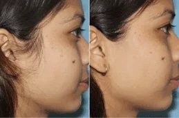 Laser-Hair-Removal-Before-and-After
