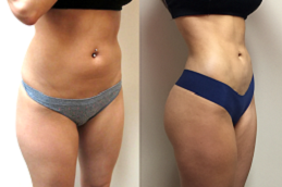 Price of liposuction dubai