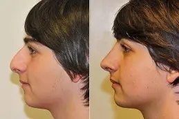 best Rinoplasty Dubai