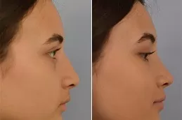 chepest Rinoplasty in Dubai