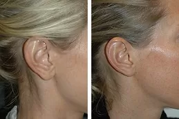 before and after Earlobe Reduction