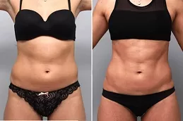 liposuction in Dubai