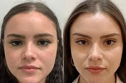 8 Point Facelift with Juvederm After and Before