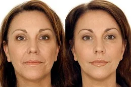 8 Point Facelift with Juvederm Before and After