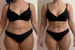 Adipose Lipolysis Injections after and before