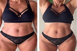 Adipose Lipolysis Injections before and after