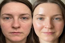 After And Before Birthmarks Removal Treatment