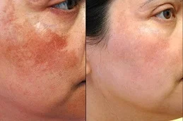 After and Before Dermal Pigmentation