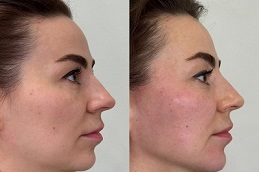 After and Before Jawline Contouring