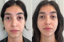 After and Before Radio Frequency Treatment