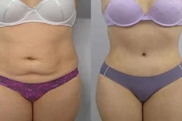 After and before Laser Liposuction