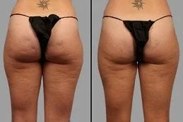 Before-After-Cellfina-Treatment-in-Dubai