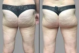 Before-After-Cellfina-Treatment