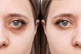 Before-After-Dark-Circle-Treatment