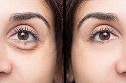 Before-After-Dark-Circles-Treatment