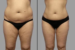 Before-After-Lipolysis-Treatment-in-Dubai