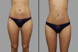 Before-After-Lipolysis-Treatment