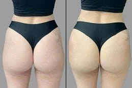 Before-After-Non-Surgical-Bum-Lift-in-Dubai