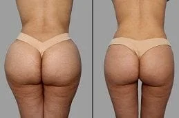 Before-After-Non-Surgical-Bum-Lift