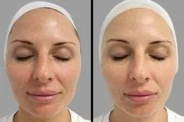 Before-After-Oxygen-Facial