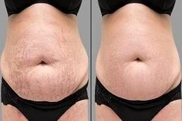 Before-After-Stretch-Marks-Removal-in-Dubai