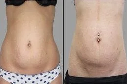Before-After-Stretch-Marks-Removal