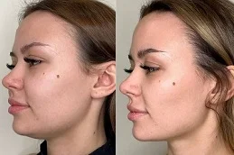Before And After Halo Treatment