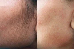 Before And After Laser Hair Bleaching