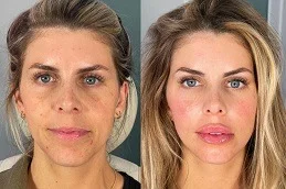 Before and After 8 Point Facelift with Juvederm
