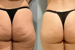 Before and After Butt Fillers