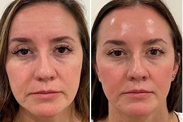 Before and After Cheek Fillers Injections