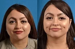 Before and After Dimple Creation