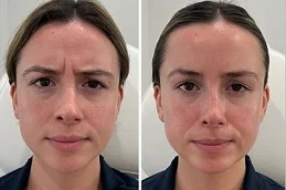 Before and After Fine Lines and Wrinkles