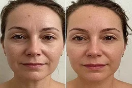 Before and After Fractional CO2 Laser Treatment