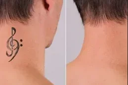 Before and After Laser Tattoo Removal