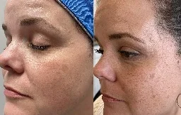 Before and After Microneedling